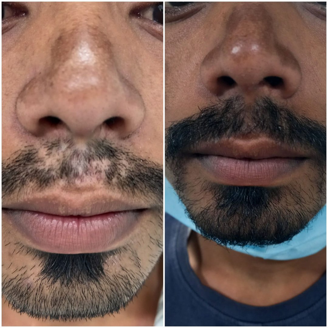 Hair Transplant Hair Transplant