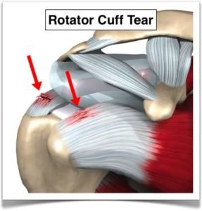 Rotator Cuff Injuries – Howard J. Luks, MD