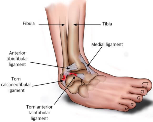 Ankle Ligament Sprain Germantown,Collierville, TN - Pittman Physical Therapy