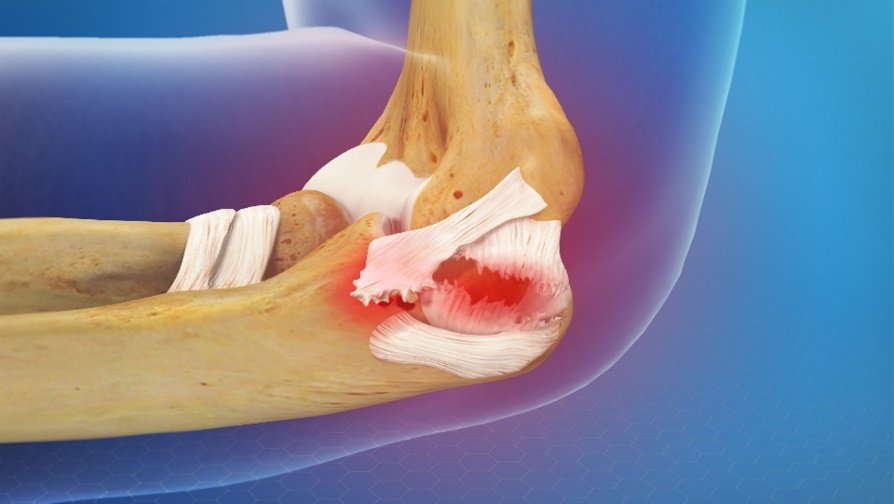 Common Sports Related Ligament Injuries 8516