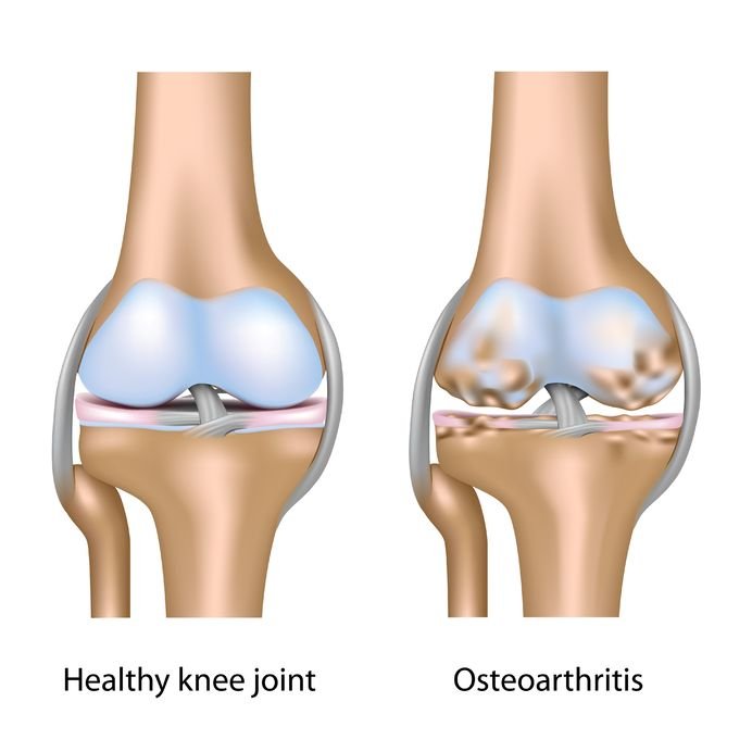 Knee Osteoarthritis Diagnosis