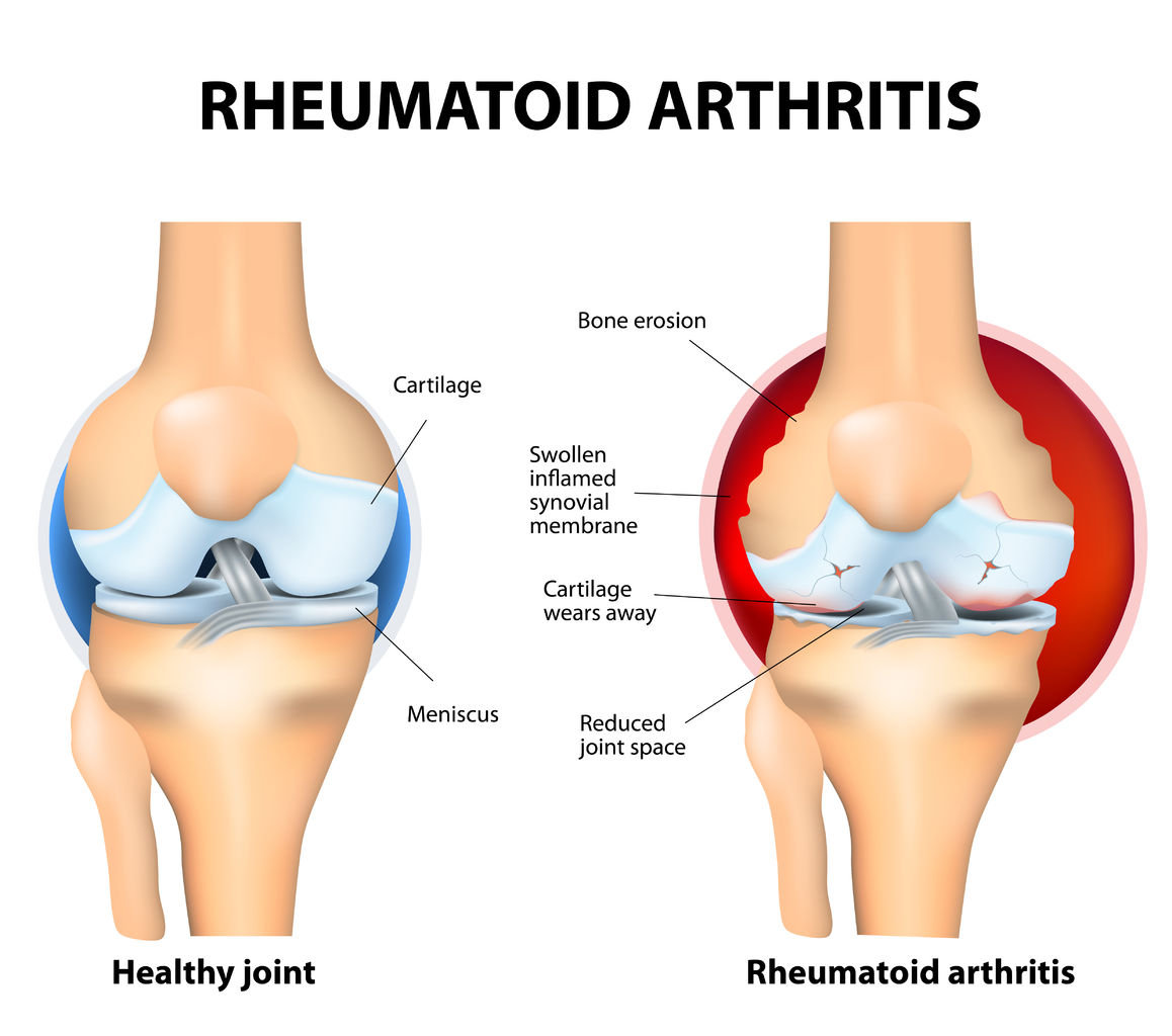 A Closer Look at Rheumatoid Arthritis Symptoms