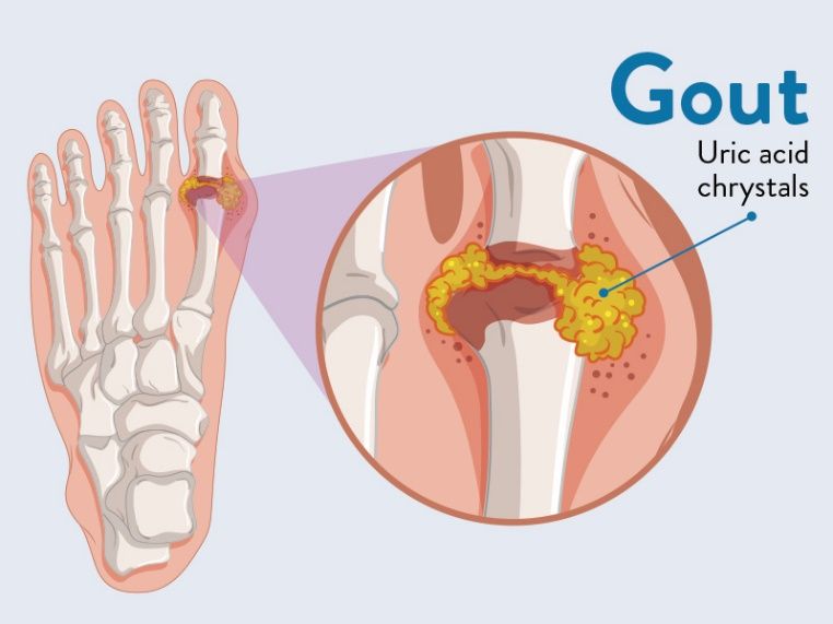 Gout Pain Specialist Clinic | Singapore Sports and Orthopaedic Clinic -  Neurosurgeon