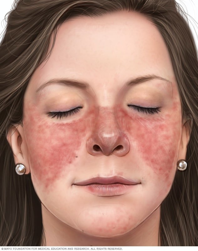 Lupus - Symptoms and causes - Mayo Clinic