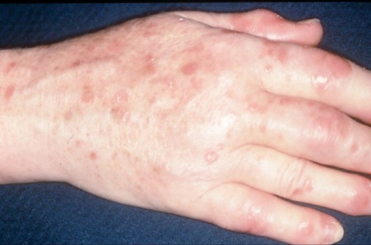 Psoriatic arthritis is an inflammatory joint condition associated with psoriasis