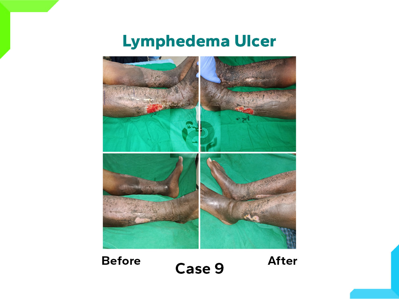 Lymphedema Ulcer Lymphedema Ulcer
