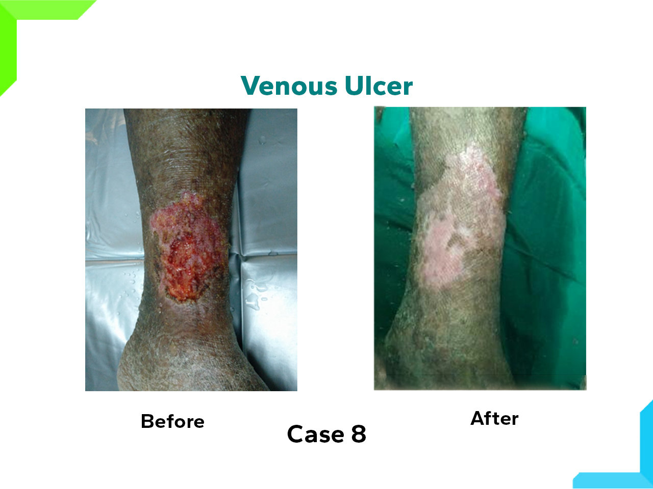 Venous Ulcer Venous Ulcer