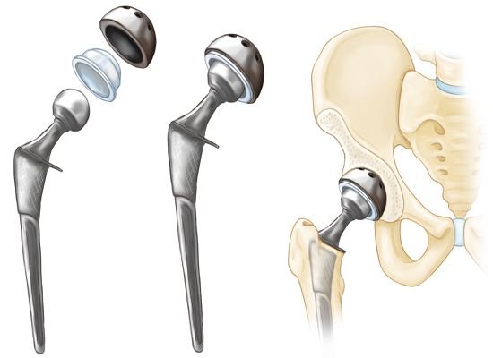 Total Hip Replacement - OrthoInfo - AAOS