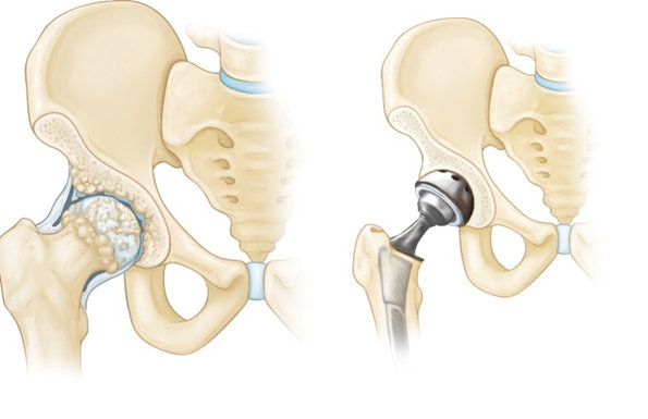 Total Hip Replacement - OrthoInfo - AAOS