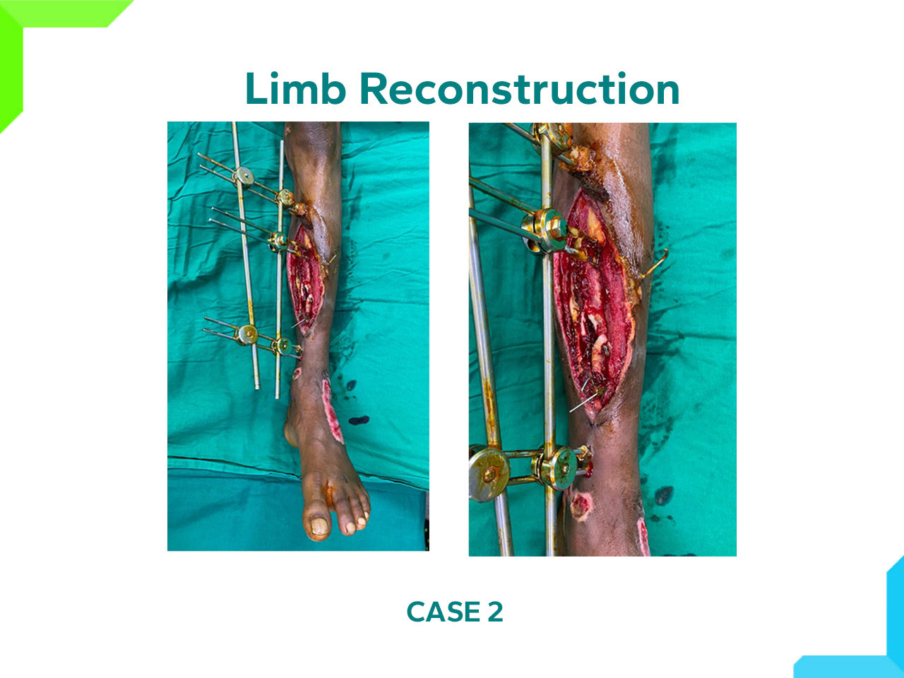 Limb Reconstruction Limb Reconstruction