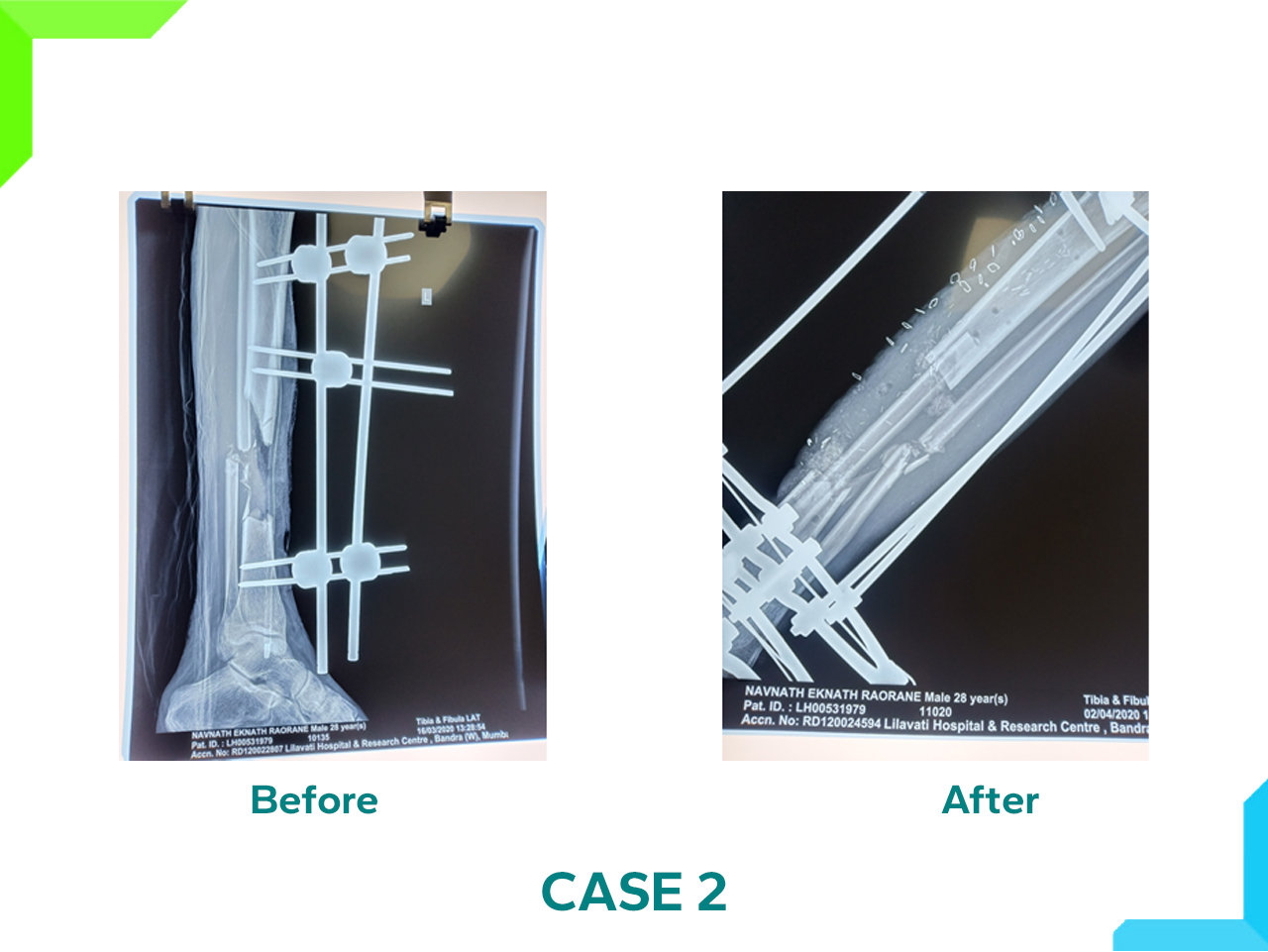 Limb Reconstruction Limb Reconstruction