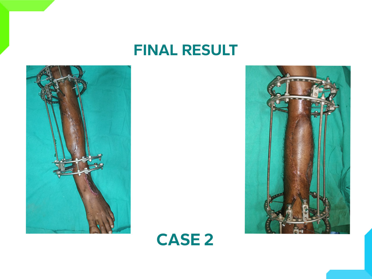 Limb Reconstruction Limb Reconstruction
