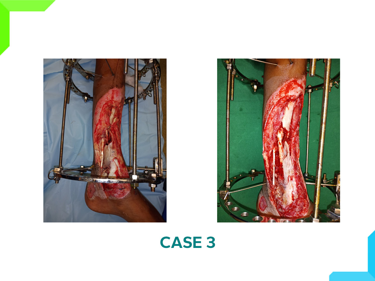 fracture fracture