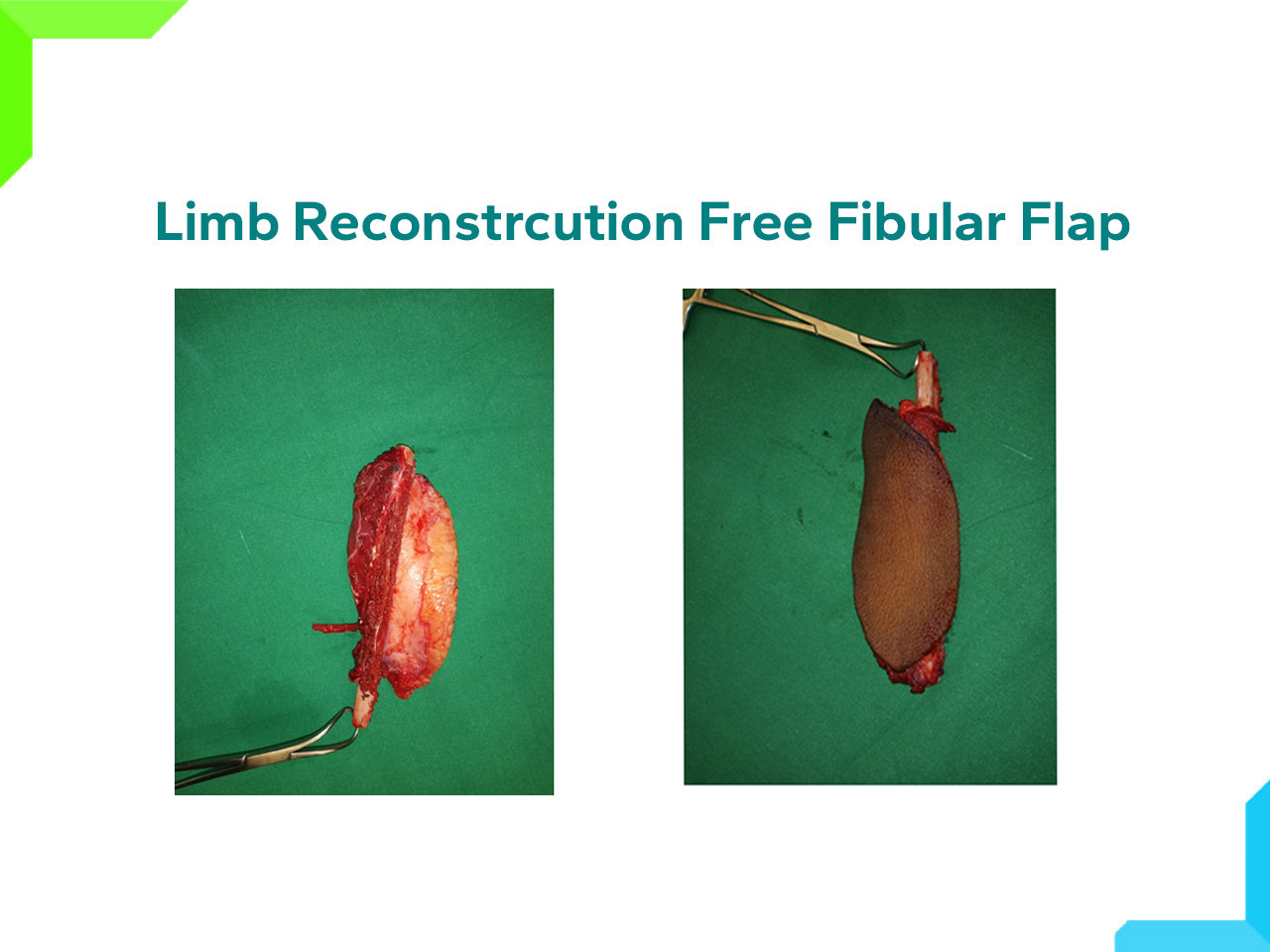 Free Fibular Flap Free Fibular Flap