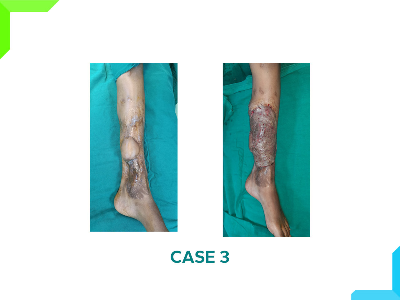 Limb Reconstruction Limb Reconstruction