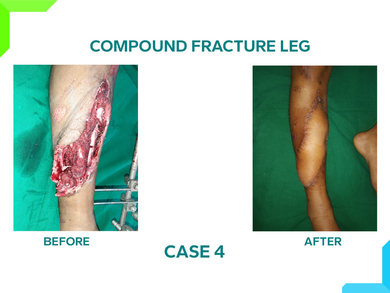 Compound Fracture leg