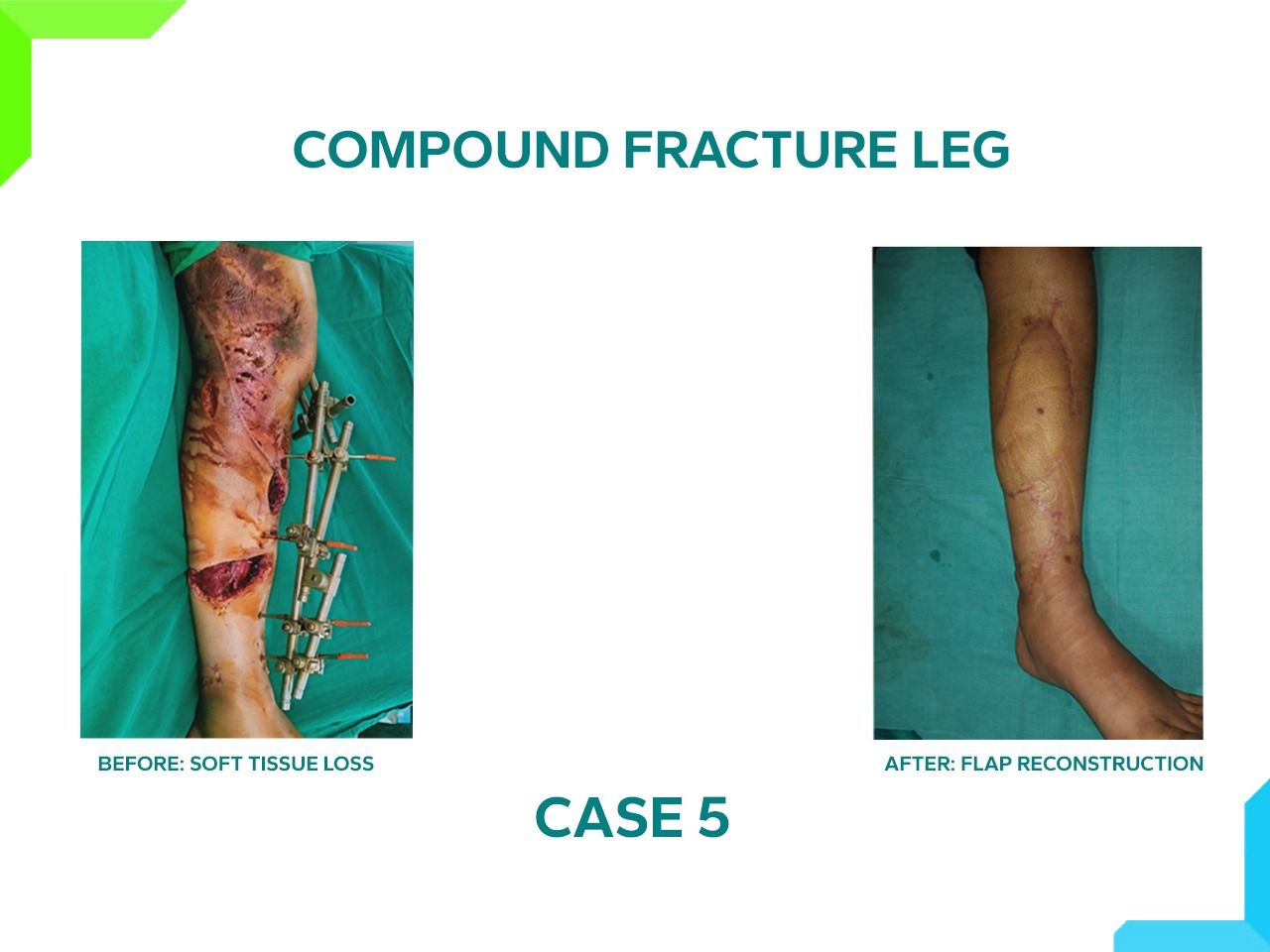 Compound Fracture leg