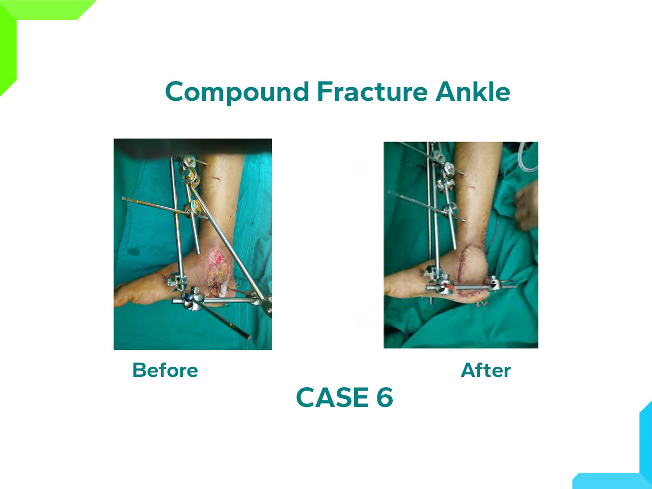 Compound Fracture Ankle Compound Fracture Ankle