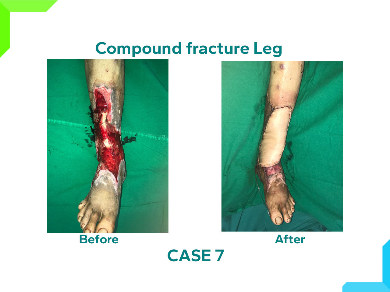 Compound Fracture Leg Compound Fracture Leg