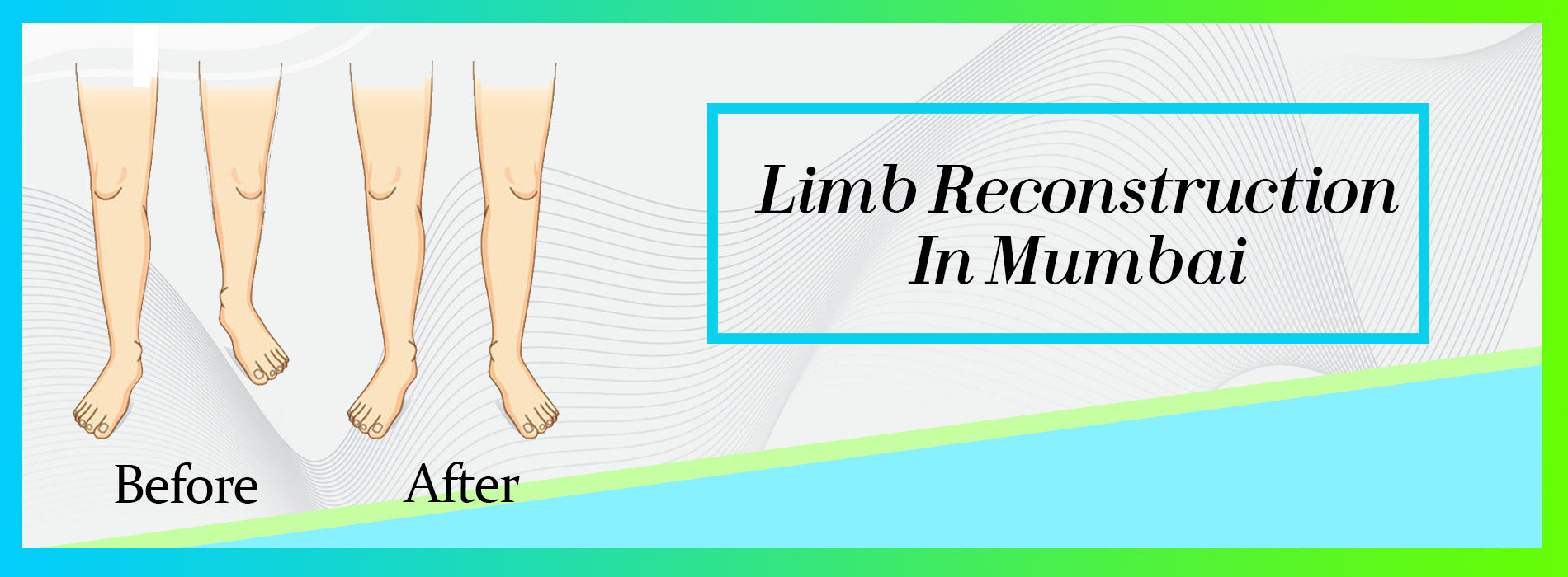 Limb Reconstruction Surgery Limb Reconstruction Surgery