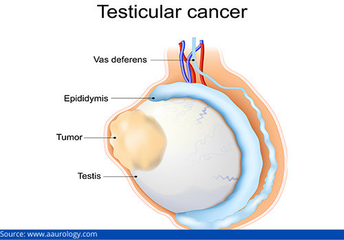 Urologic Cancers Types Symptoms And Treatments Dr Sumanta Mishra 1604