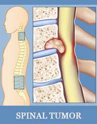 Spine Tumor Doctor, Hospital, Spinal Tumor Treatment in Ahmedabad, Gujarat,  India