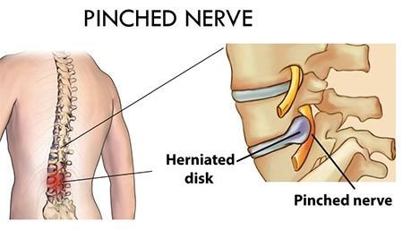Pinched Nerve Treatment in NJ | Pain Management Doctor, Specialist