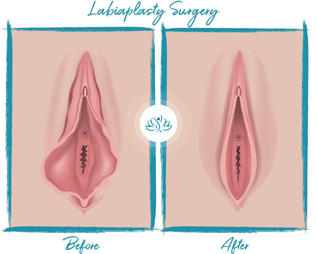 Labiaplasty NYC | Best Labiaplasty Surgeon in New York