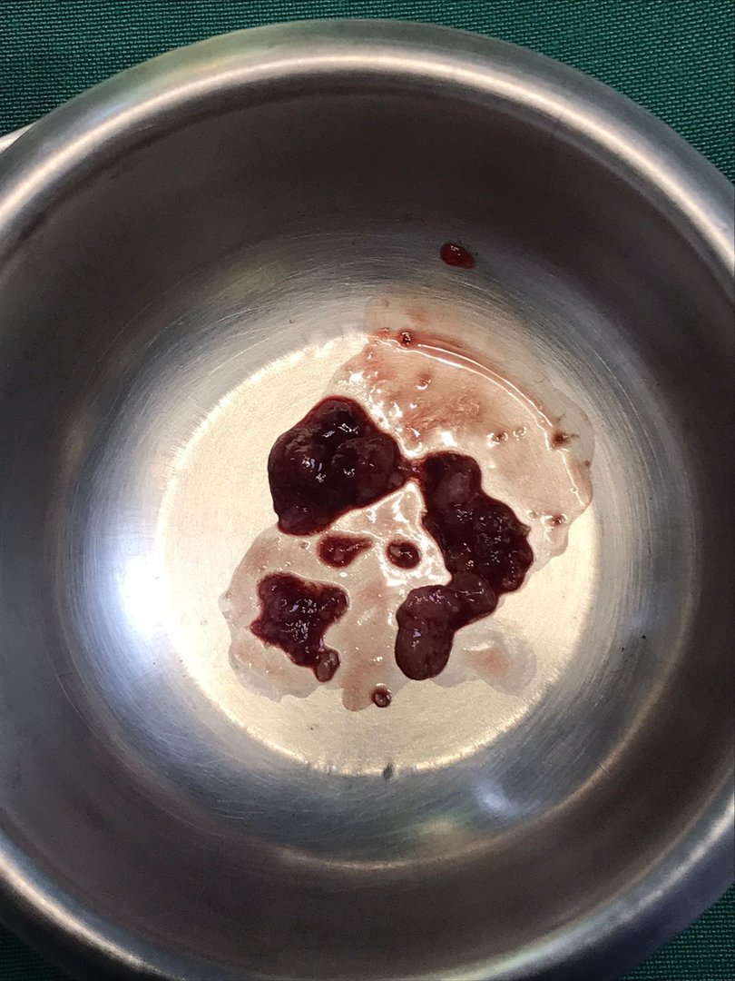 Endometrial polyps Endometrial polyps