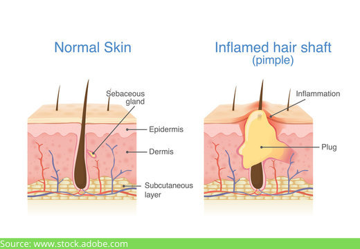 acne scars