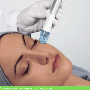Dermabrasion