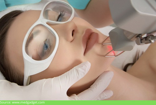 Laser resurfacing