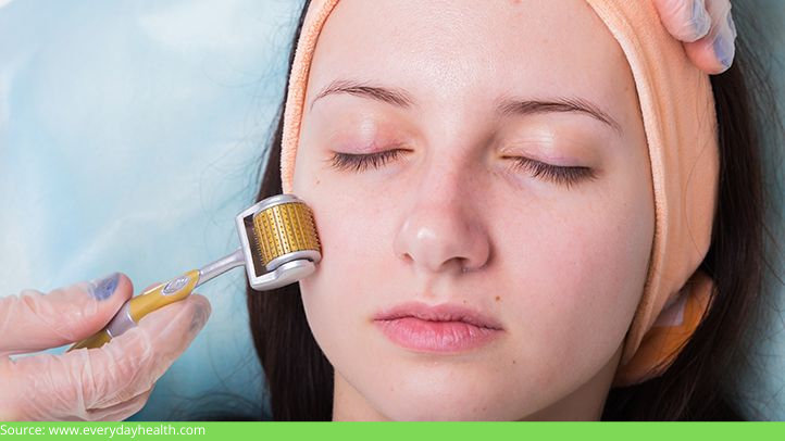 Microneedling