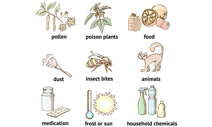 Living with Eczema | Health Plus