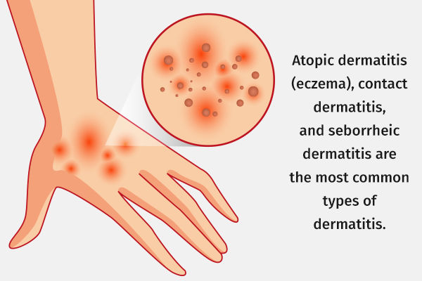 Dermatitis: Causes, Symptoms, and Medical Treatment