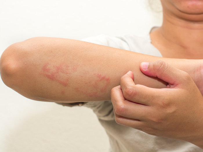 How to Treat Eczema