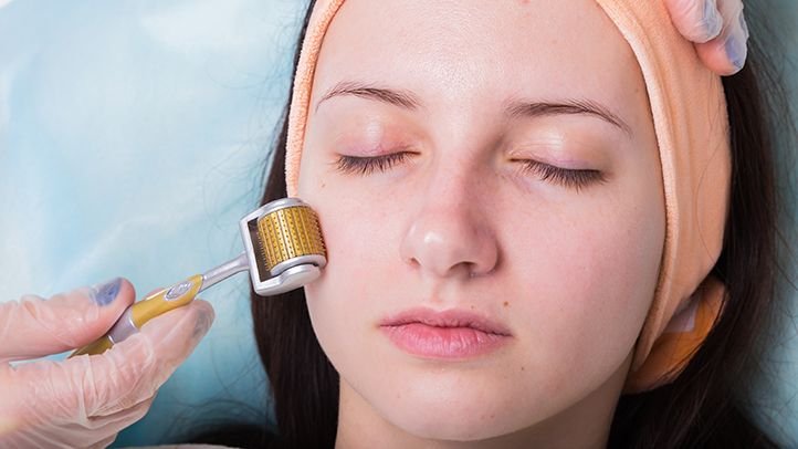 Microneedling