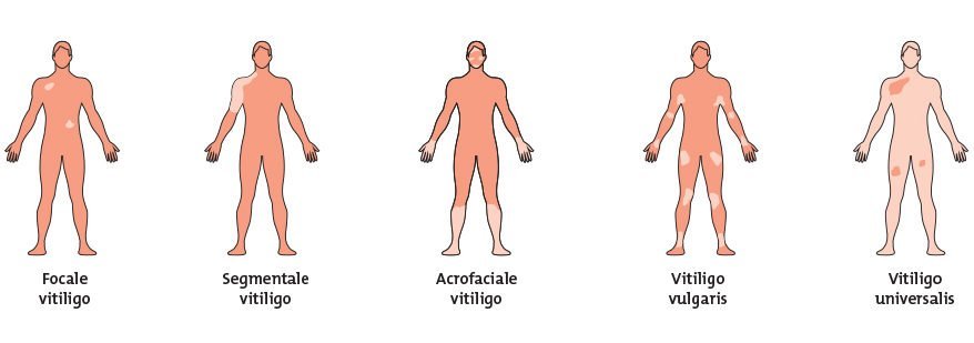 Types of vitiligo