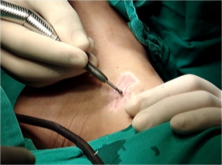 Surgical treatment