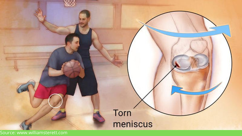 torn meniscus