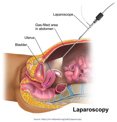 Laparoscopy