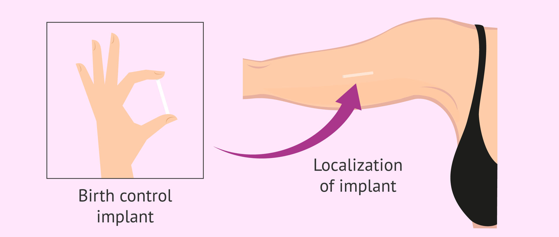 Birth Control Implant: Advantages and Disadvantages