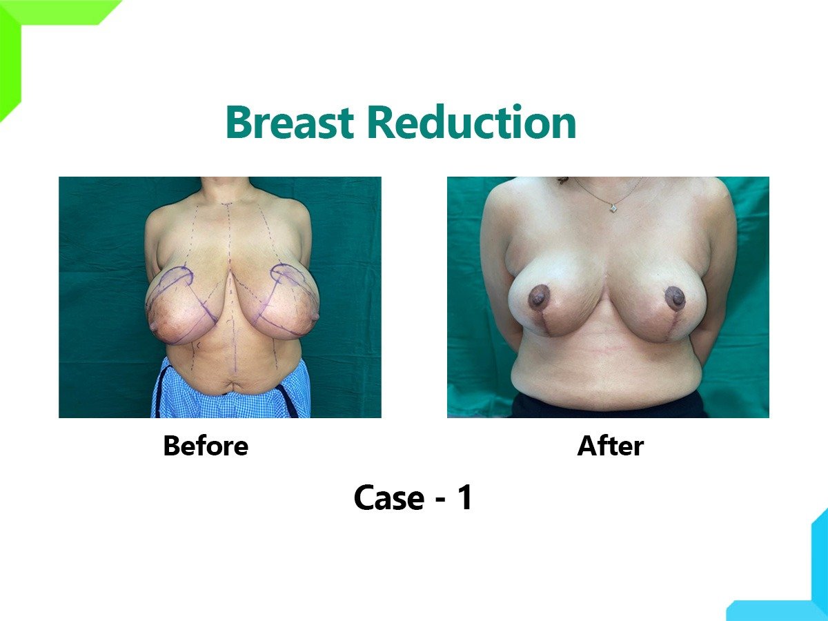 Breast Reduction Breast Reduction