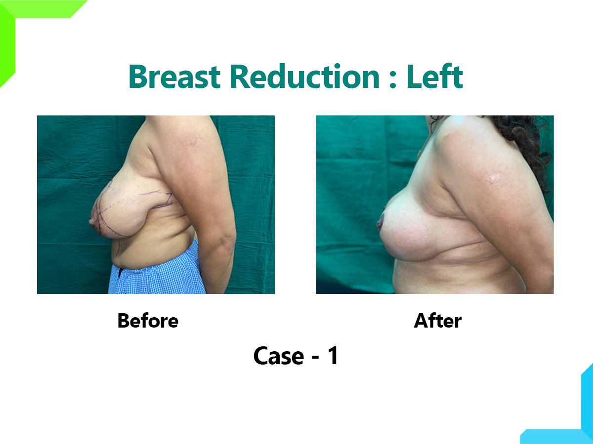 Breast Reduction Breast Reduction