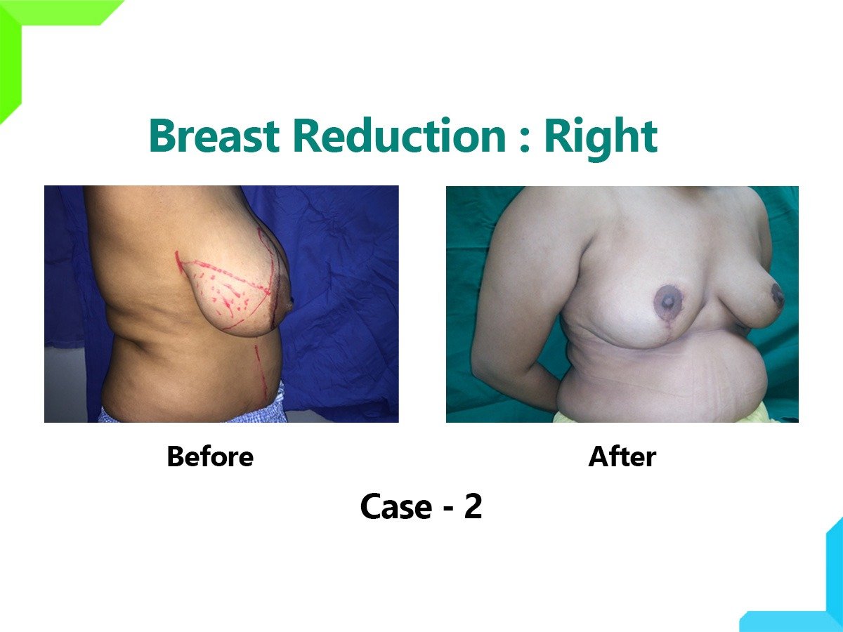 Breast Reduction Breast Reduction