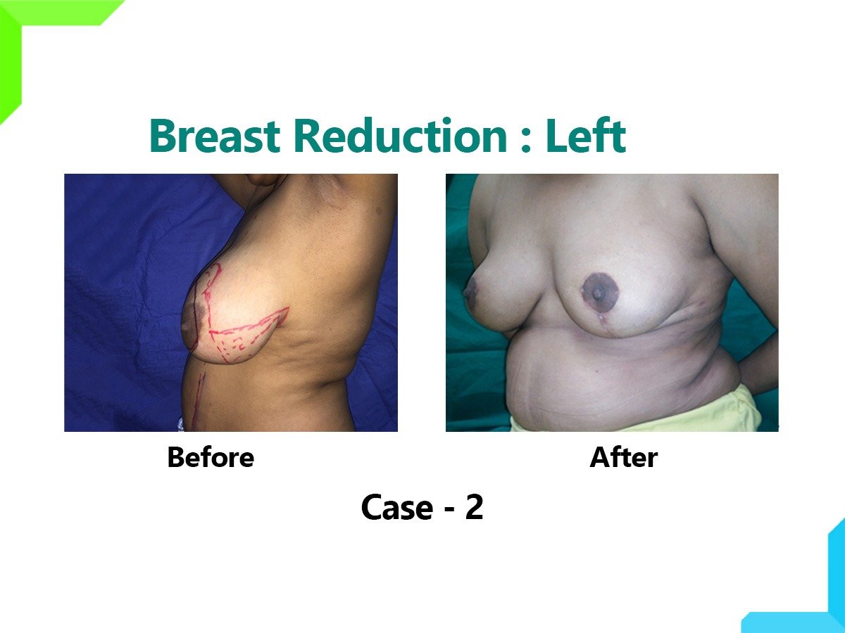 Breast Reduction Breast Reduction
