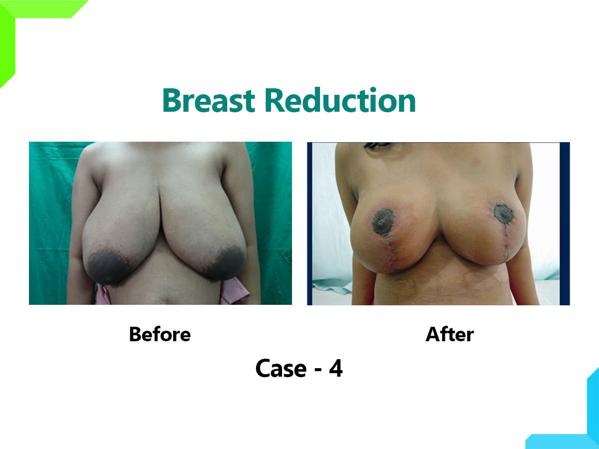 Breast Reduction Breast Reduction