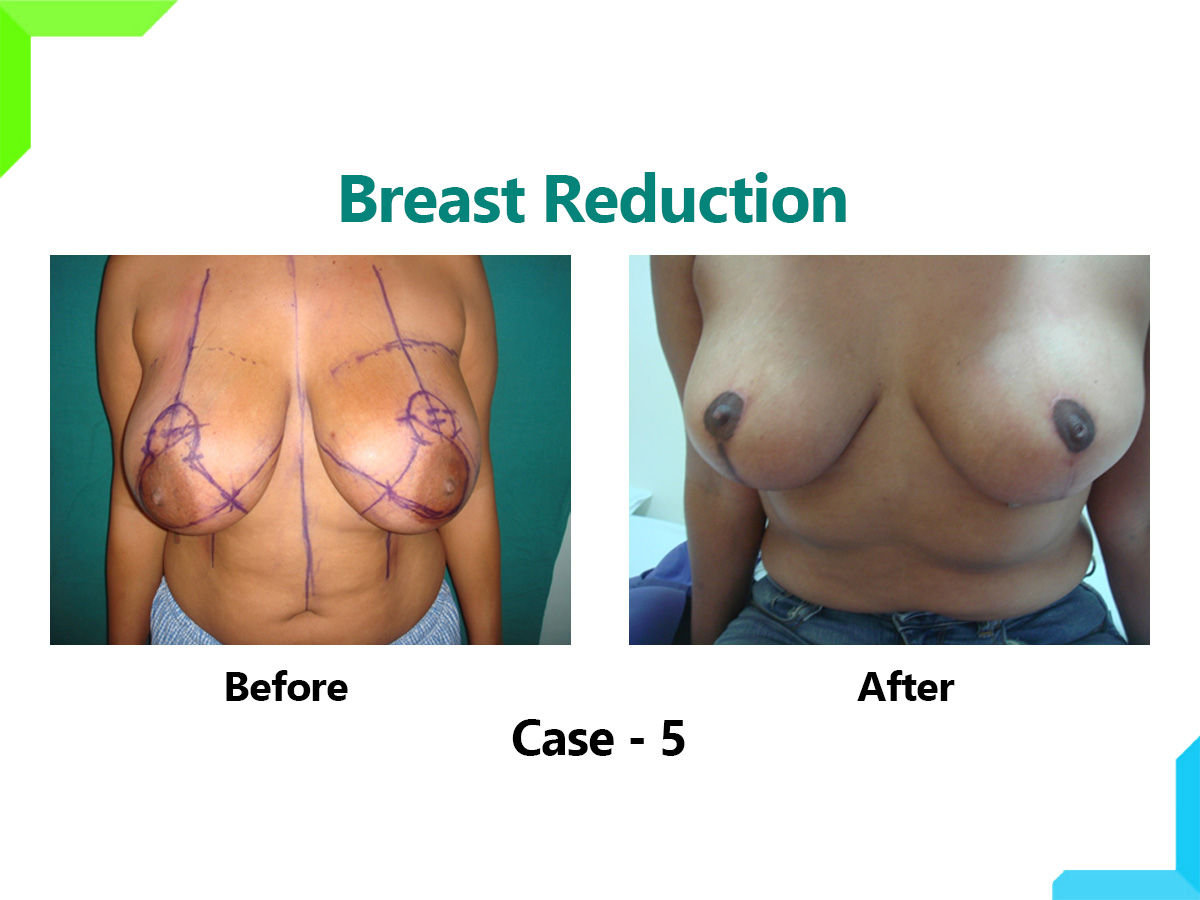 Breast Reduction Breast Reduction