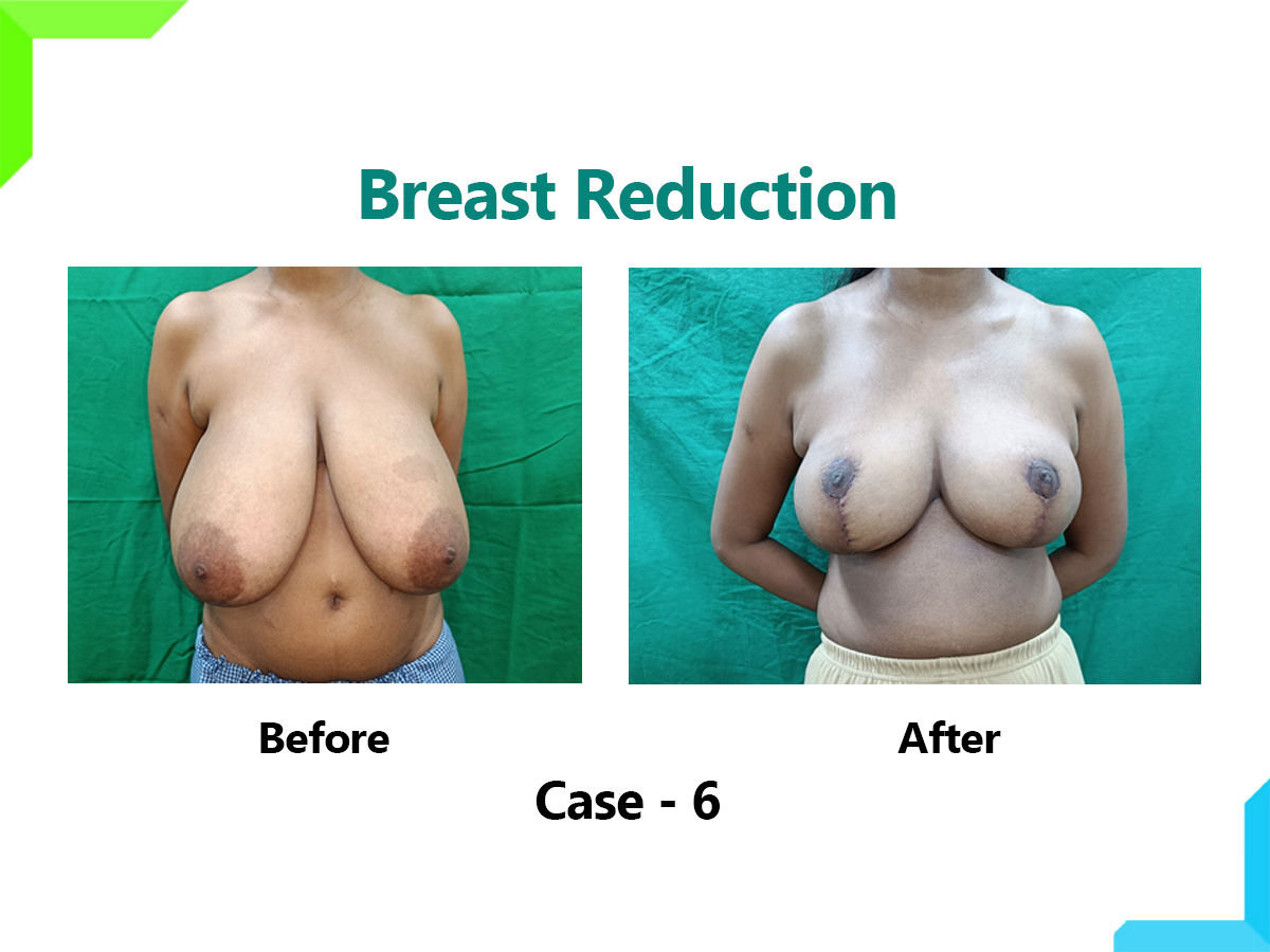Breast Reduction Breast Reduction