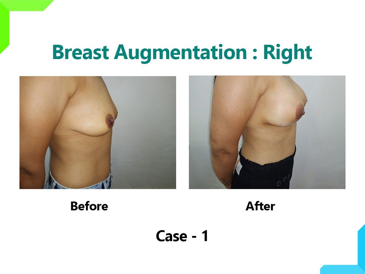 Breast Augmentation Breast Augmentation